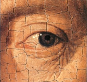 Blefaroplastia